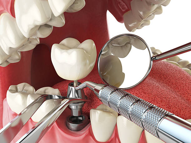 Emergency Dental Filling Replacement in ID